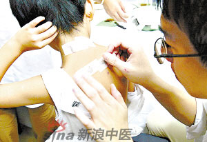 灸法的種類  你知道多少？