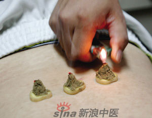 灸法的種類  你知道多少？
